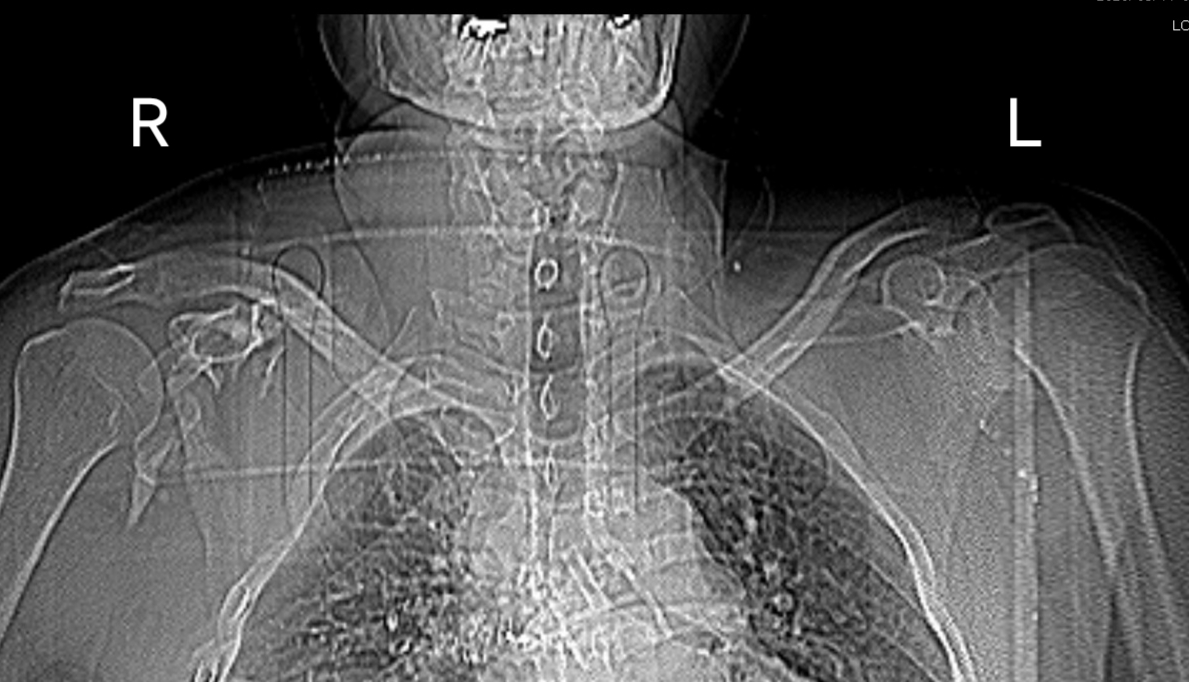 Shattered shoulder